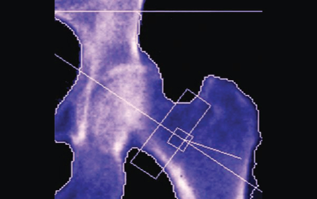 Identifying Risk of Osteoporotic Fracture