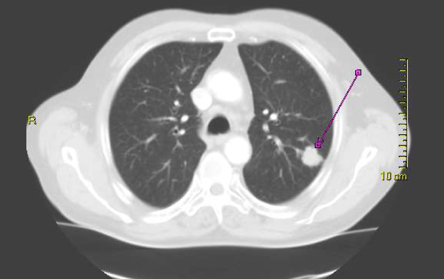 Lung Cancer Screening Recommendations