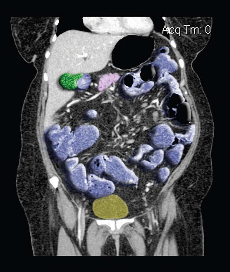New Options for Imaging in Crohn’s Disease