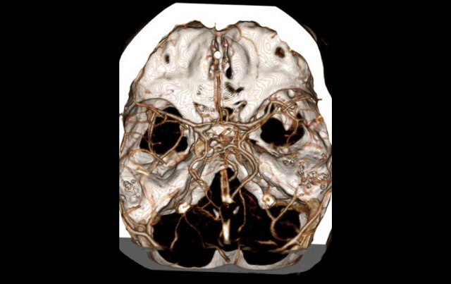 Imaging Options for Acute Stroke and TIA Patients