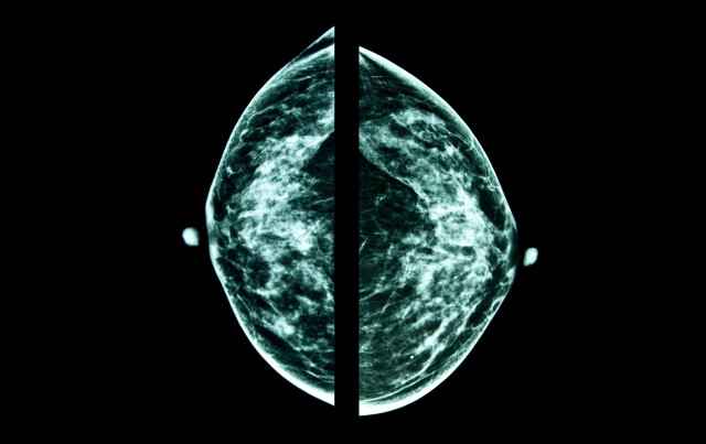 Breast Cancer Screening in an Era of Personalized Regimens