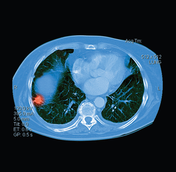 Low-Dose Evaluation of Pulmonary Nodules