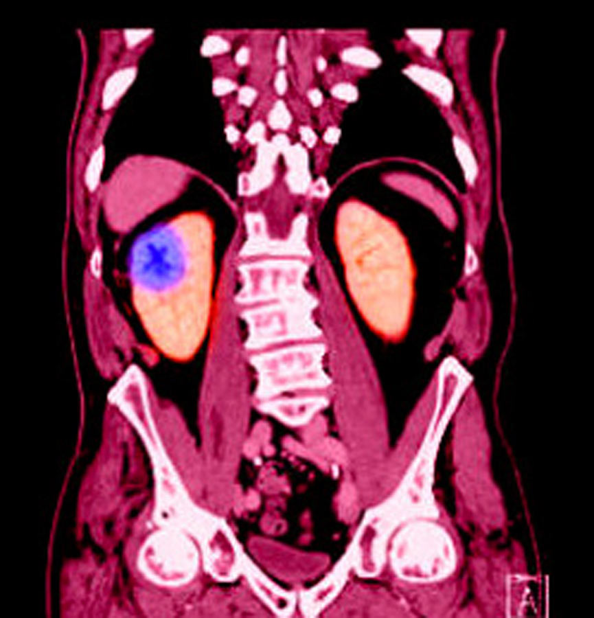 Percutaneous Ablation of Renal Masses