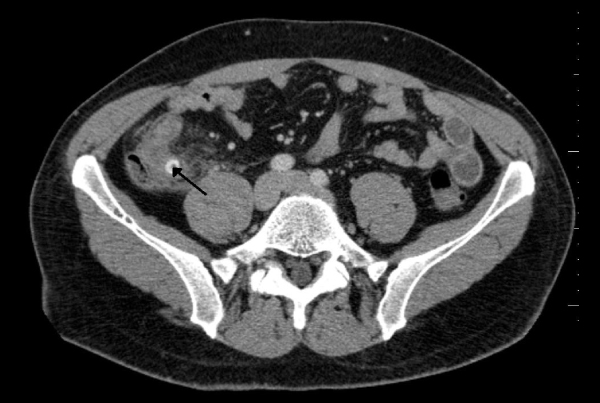 Assessing Appendicitis in Teens and Young Adults