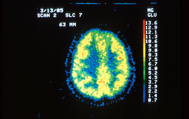 Adding Quantitative Analysis to Brain Scans