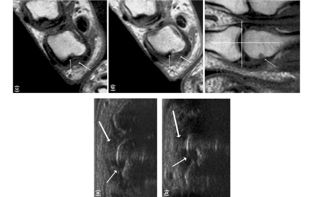 Bone Edema on MRI May Predict Rheumatoid Arthritis