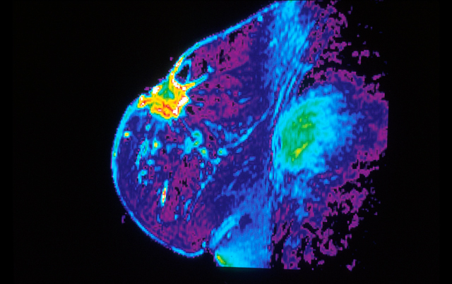Breast MRI Needed for High-Risk Patients