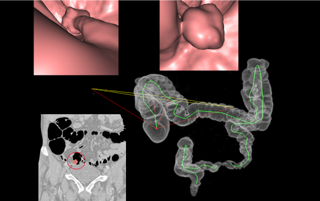 CT Colonography versus Colonoscopy