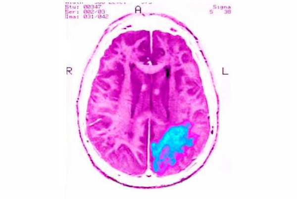 Cerebrovascular Disease: Achieving Clarity