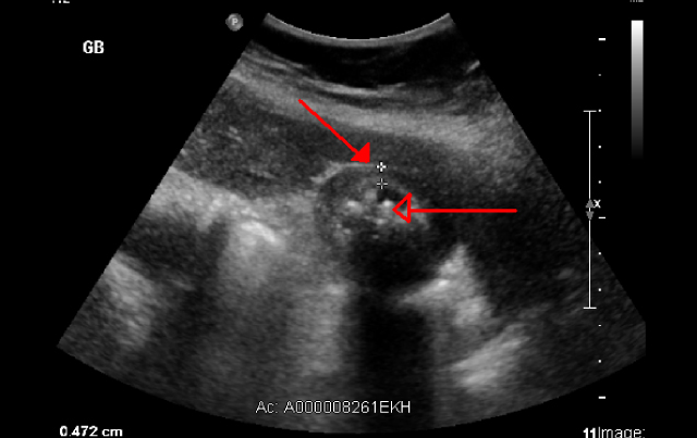 Diagnosing Acute Cholecystitis