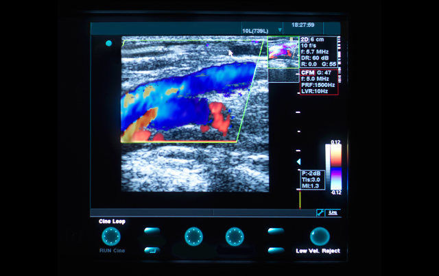 Diagnosing Deep Venous Thrombosis