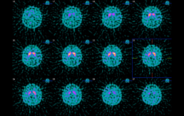 Essential Tremor Versus Parkinsonian Syndromes