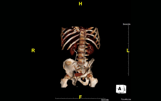 Identifying Underlying Causes of Hematuria