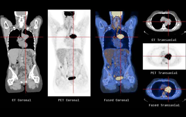 Improvements in Lung Cancer Staging