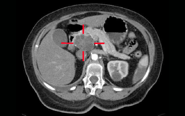 Interventional Radiology’s Role in Pancreatic Cancer