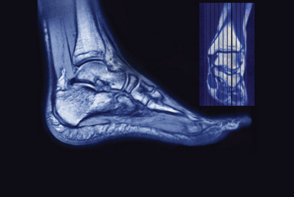 MRI and Forefoot Pain