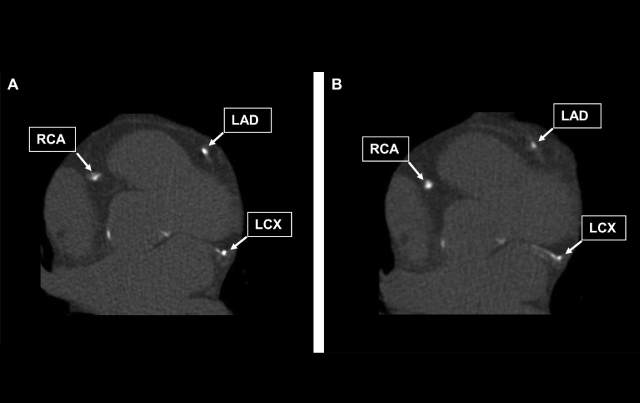 Making Coronary Artery Calcification Screenings Safer