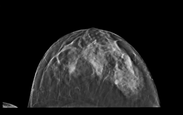 Mammography Debate Continues