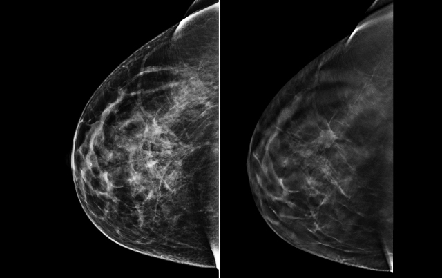 Mammography and the Risk of Thyroid Cancer