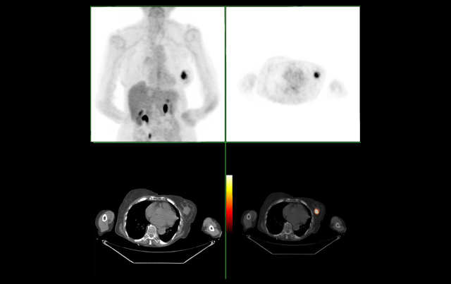 Molecular Imaging Aids in Presurgical Planning