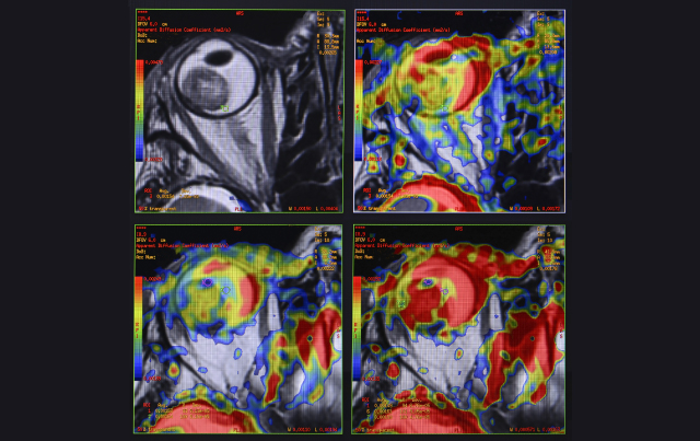 Neuroimaging in Ophthalmology