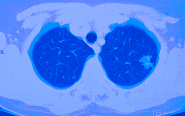 New CMS Guidelines for Lung Cancer Screening Approval