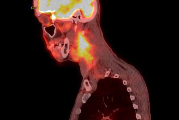 New Imaging Options for Head and Neck Cancer