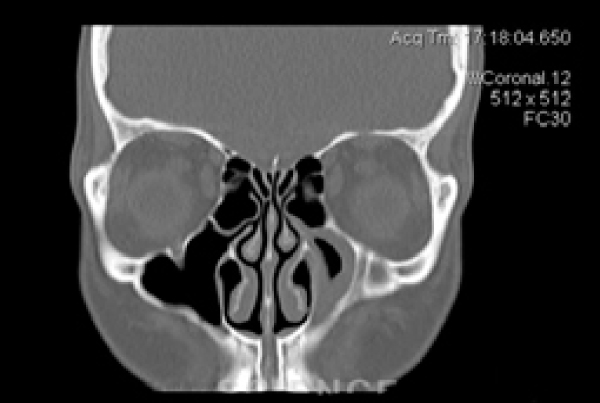 New Recommendations for Chronic Rhinosinusitis