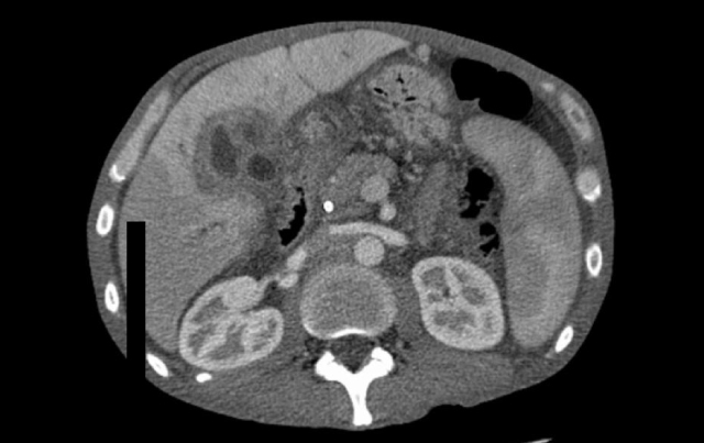 Radioembolization: An Option for Colorectal Cancer Patients with Liver Metastases