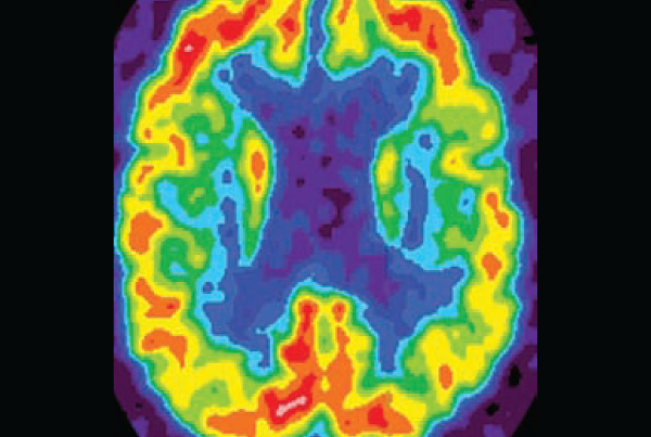 SMIL Among First to Offer Florbetapir for Alzheimer’s Evaluation