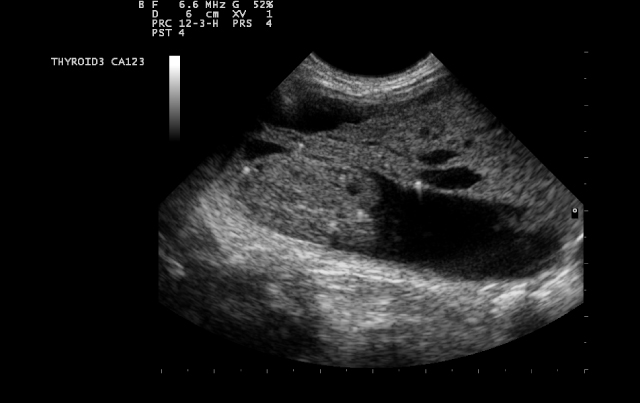 Ultrasound Imaging for Evaluating Thyroid Nodules