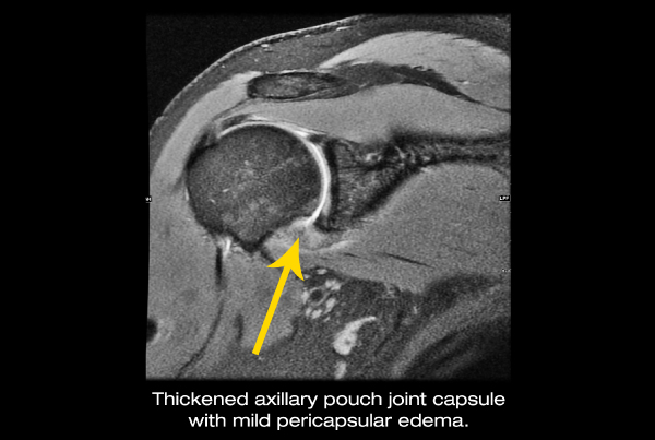 Adhesive capsulitis (AC) or “Frozen Shoulder”