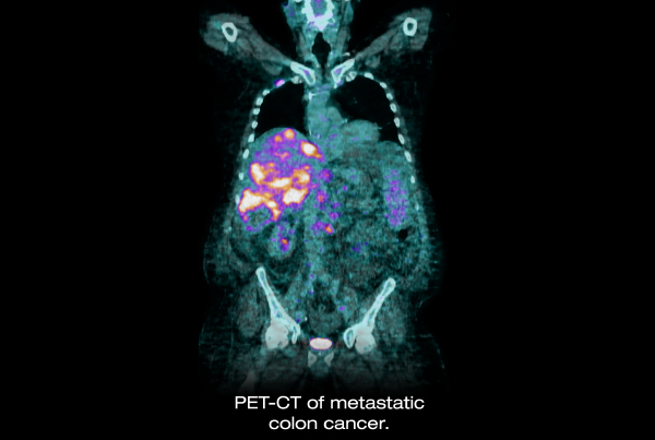 Radioembolization of Metastatic Colorectal Cancer