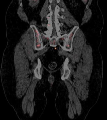 Axumin PET Scans and Recurrent Prostate Cancer