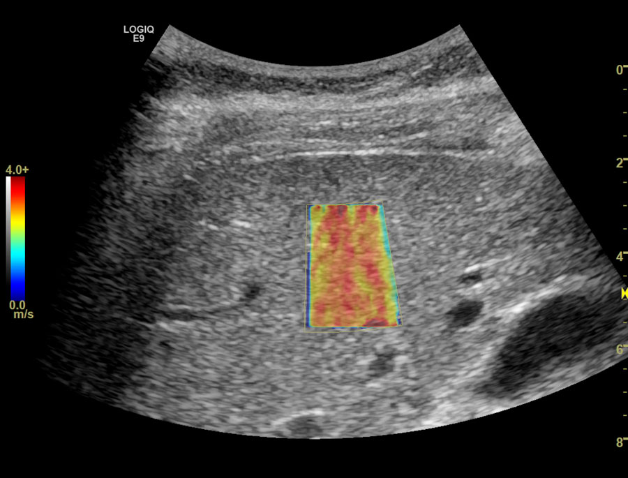 A better evaluation of liver fibrosis